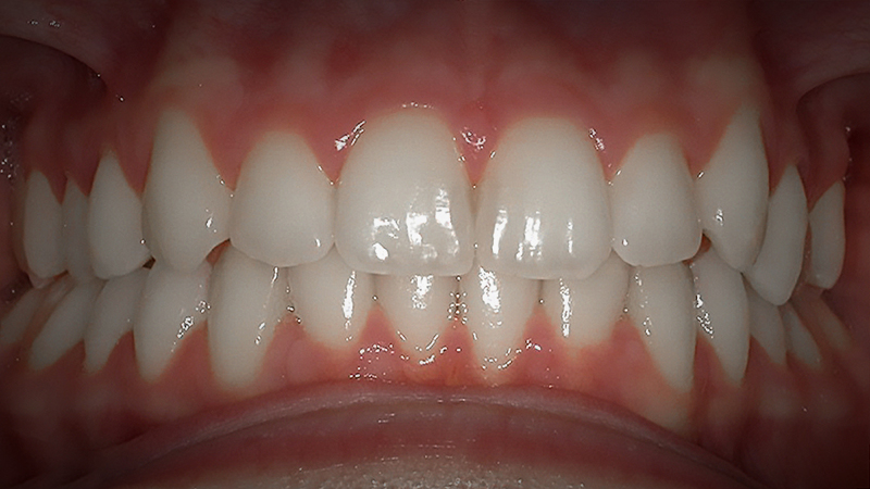 After image